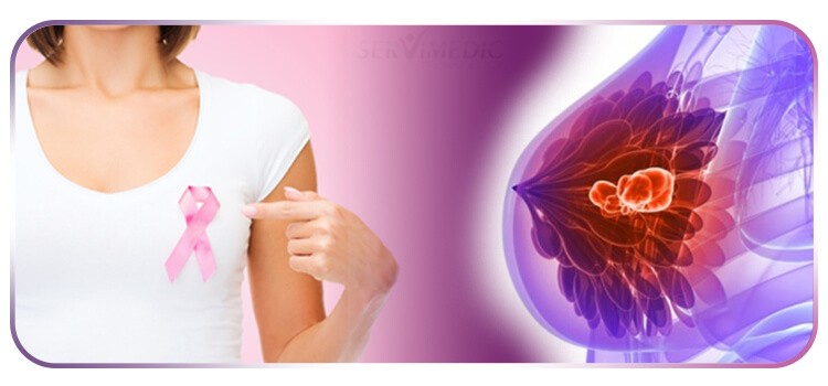 cancer de mama sintomas